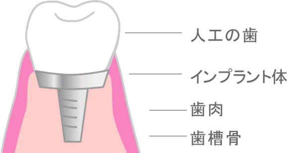 人工の歯 インプラント体 歯肉 歯槽骨